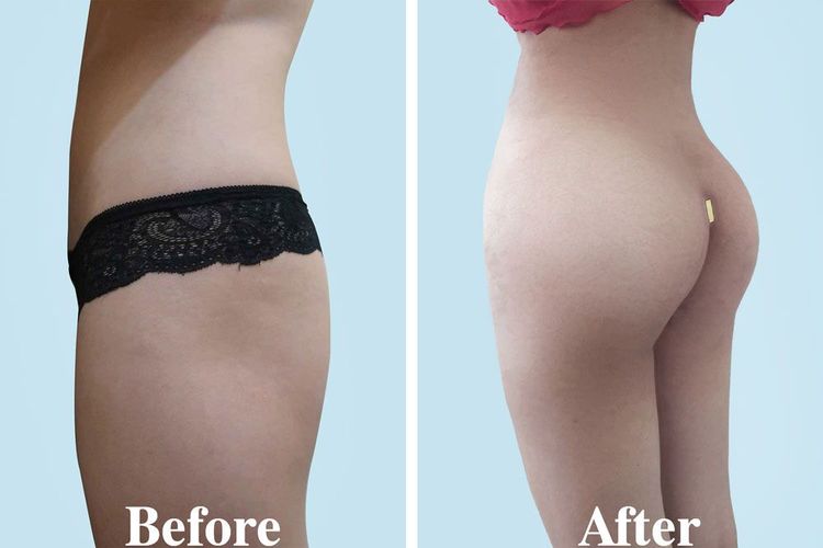 A 28-year-old client before and after 2 days of undergoing endoscopic butt lift and liposuction of the flanks.