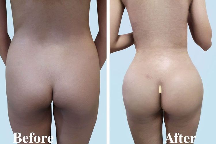 A 24-year-old client underwent waistline liposuction and endoscopic butt lift. 