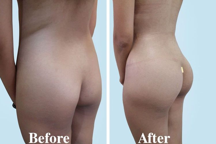 A 24-year-old client underwent waistline liposuction and endoscopic butt lift. 