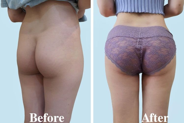 A 35-year-old client before and after 2 days of undergoing endoscopic butt lift and liposuction of the flanks.