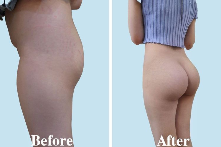 A 35-year-old client before and after 2 days of undergoing endoscopic butt lift and liposuction of the flanks.