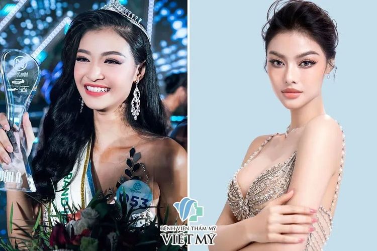 Phụ nữ sau nâng ngực cần tầm soát ung thư vú định kỳ.