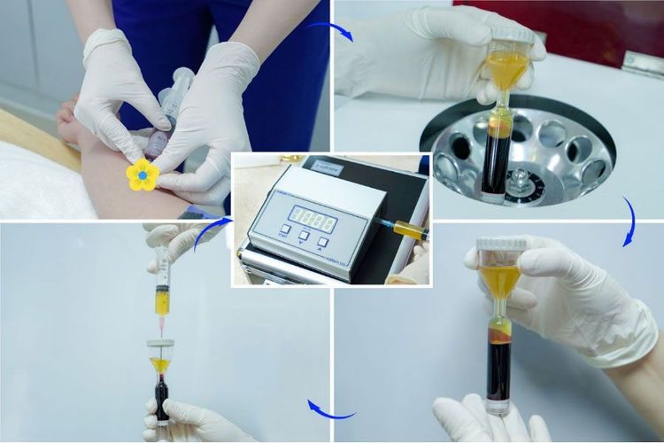 Quy trình chiết tách PRP tại bệnh viện Việt Mỹ