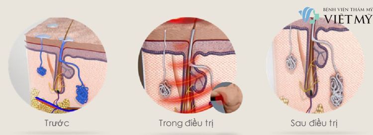 triệt mồ hôi nách không đau