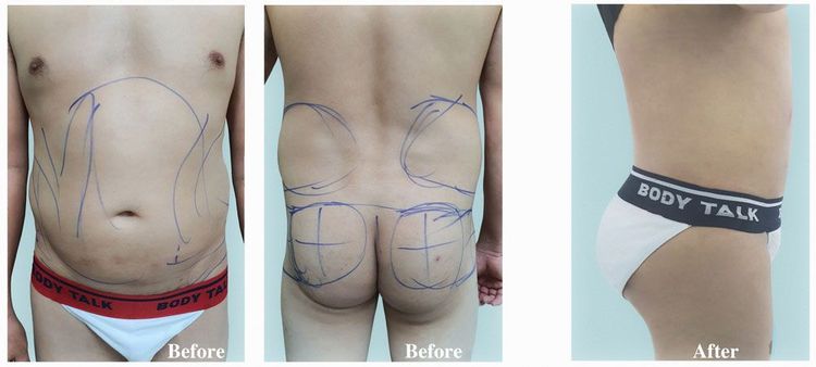 A 40-year-old male client underwent liposuction and butt augmentation using autologous fat.
