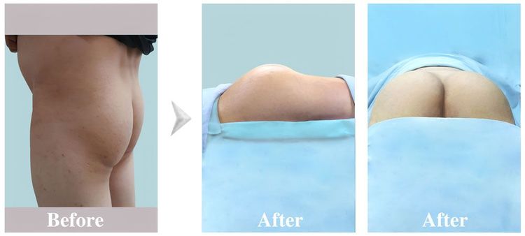 A 40-year-old male client underwent liposuction and butt augmentation using autologous fat.