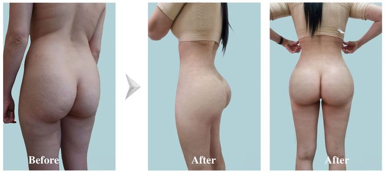 The horizontal marks on the skin are from wearing a specialized shirt.