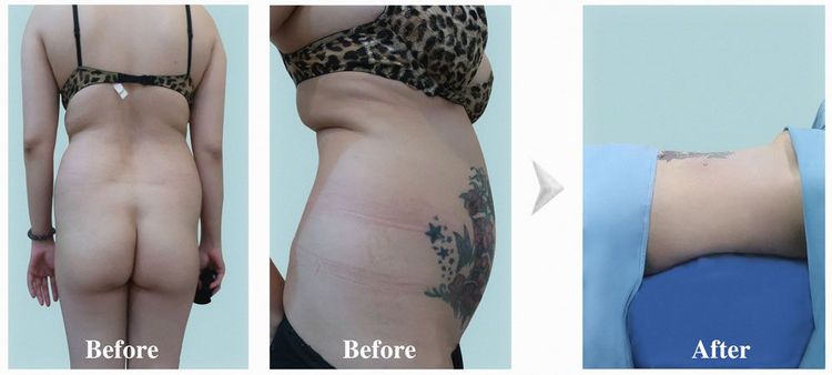 A 45-year-old client underwent liposuction and butt augmentation using autologous fat.