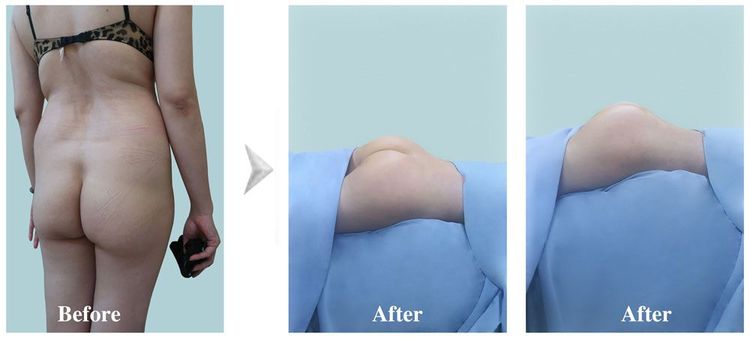 A 45-year-old client underwent liposuction and butt augmentation using autologous fat.