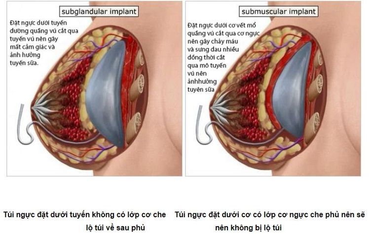 tui nguc