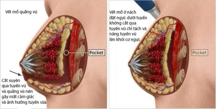 vet mo tui nguc