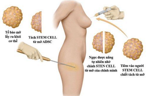 Mỡ sẽ được hút ra từ cơ thể rồi tiêm lại vào vùng ngực sau khi đã tinh lọc. 