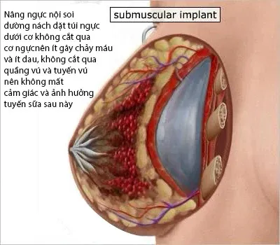 Hình ảnh 1: đặt túi ngực dưới cơ.