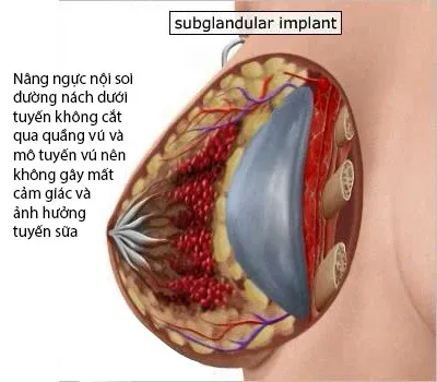 Nâng ngực nội soi đường nách đặt dưới tuyến.