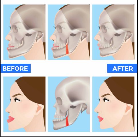Jaw orthognathic surgery