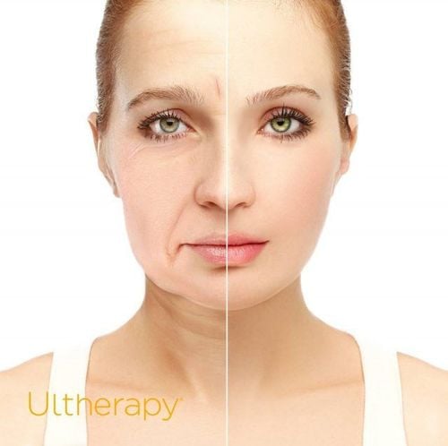 Ultherapy nâng cơ trẻ hóa da