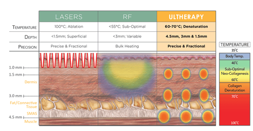 Ultherapy tác động đến độ sau 4.5mm mà không ảnh hưởng đến bề mặt da