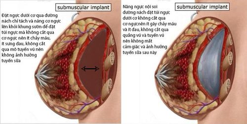 Đặt túi ngực dưới cơ qua đường nách