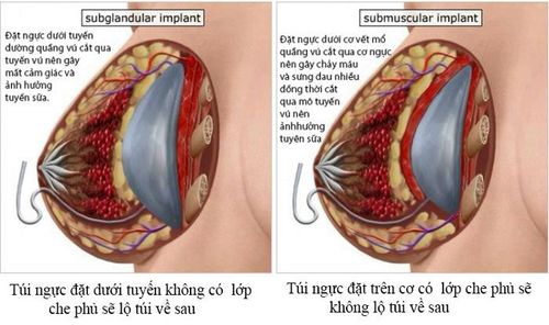 Đăt túi ngực dưới cơ và dưới tuyến đường quầng vú