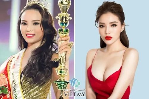 Đau đầu ti sau nâng ngực khiến nhiều chị em lo lắng