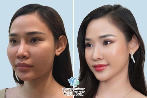 Hạ thấp gò má - Bác Sĩ Chiêm Quốc Thái