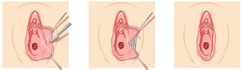 Phẫu thuật thu nhỏ môi âm hộ