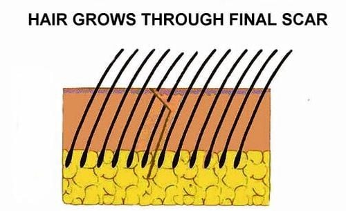 kỹ thuật khâu sẹo