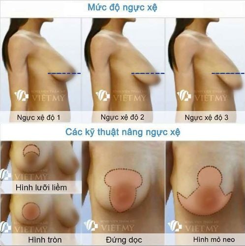 kỹ thuật nâng ngực xệ