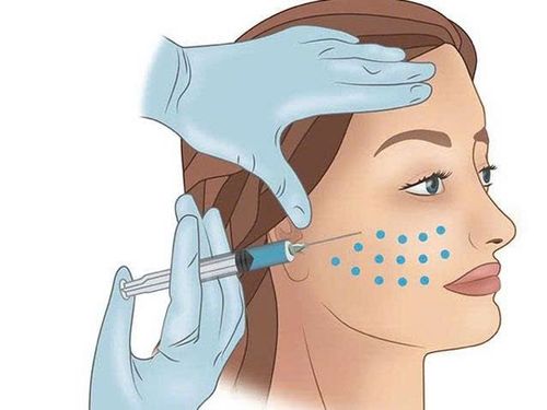 Mesotherapy điều trị nám