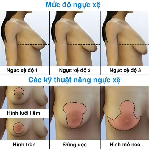 Nâng ngực chảy xệ - Bác sĩ Chiêm Quốc Thái