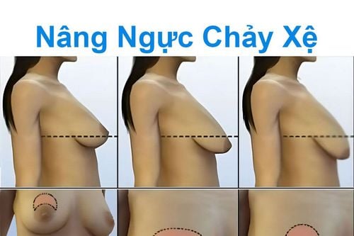 Nâng ngực chảy xệ - Bác sĩ Chiêm Quốc Thái