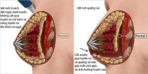 Hình ảnh 2: đặt túi ngực dưới  tuyến, đường nách và quầng vú.