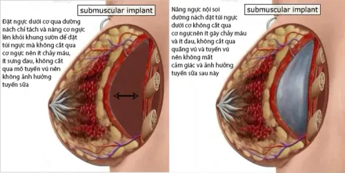 Nâng ngực nội soi đường nách đặt dưới cơ.