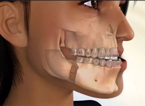Phẫu thuật điều trị hàm móm: Giải pháp tối ưu để cải thiện chức năng và thẩm mỹ