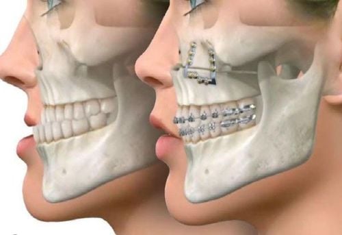 Phẫu thuật điều trị hàm móm: Giải pháp tối ưu để cải thiện chức năng và thẩm mỹ