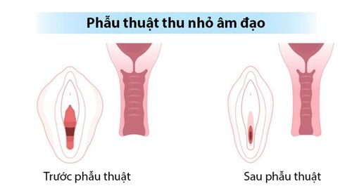 Phẫu thuật thu nhỏ âm đạo
