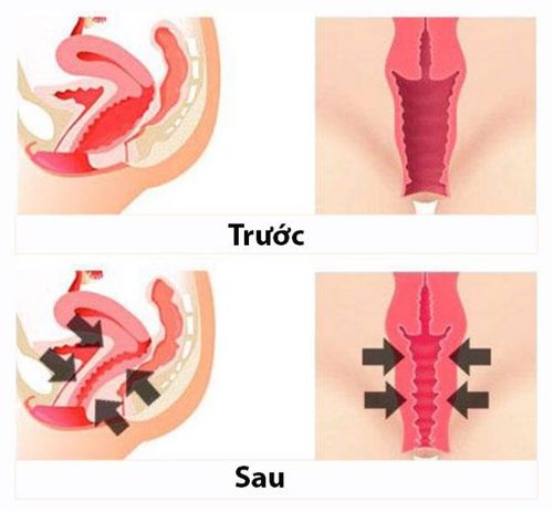Phẫu thuật thu nhỏ âm đạo