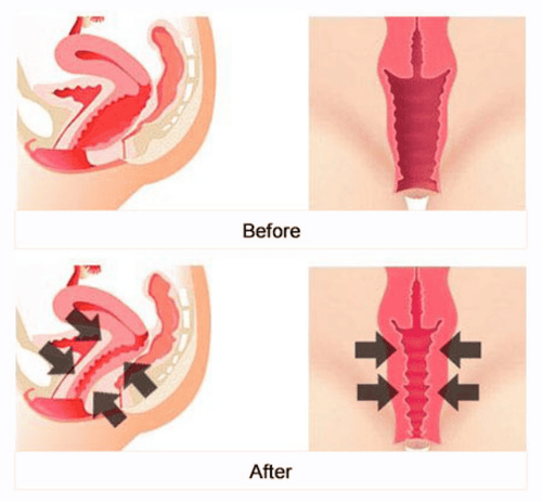 Vaginoplasty