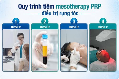 Điều trị rụng tóc bằng PRP huyết tương giàu tiểu cầu 