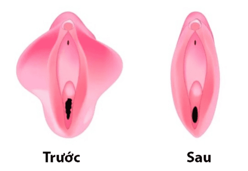 Phẫu thuật thu nhỏ môi âm hộ