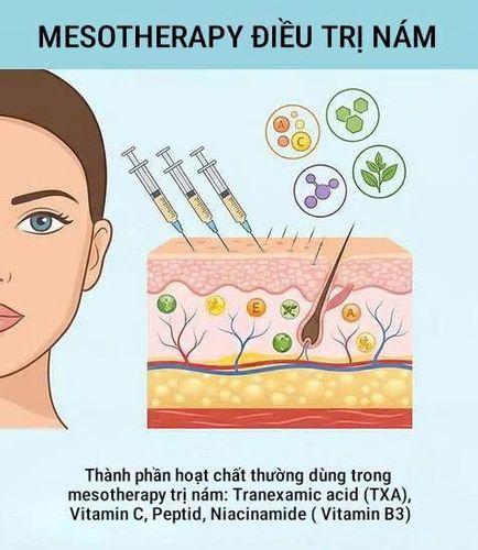 Mesotherapy điều trị nám