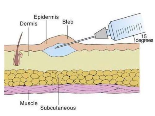 Mesotherapy điều trị nám