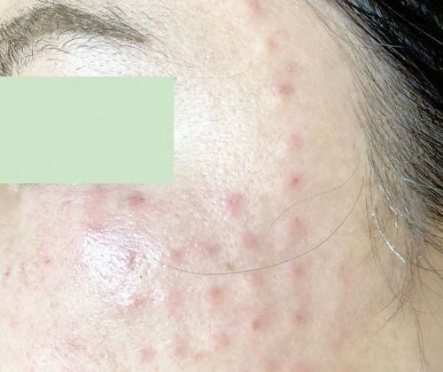 Mesotherapy trẻ hóa da