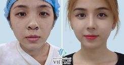 Hình trước sau thu gọn cánh mũi
