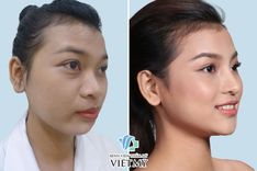 Nâng mũi là gì? Các phương pháp nâng mũi hiện đại