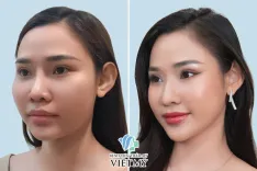 Hạ thấp gò má - Bác Sĩ Chiêm Quốc Thái