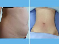 Hình ảnh trước sau hút mỡ bụng: Kết quả thực tế