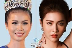 Chi phí nâng mũi hết bao nhiêu tiền