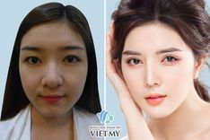 Nâng mũi có ảnh hưởng đến chức năng hô hấp không?