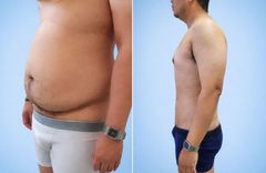 Hút mỡ bụng cho Nam: Giải pháp cho vùng bụng khó giảm